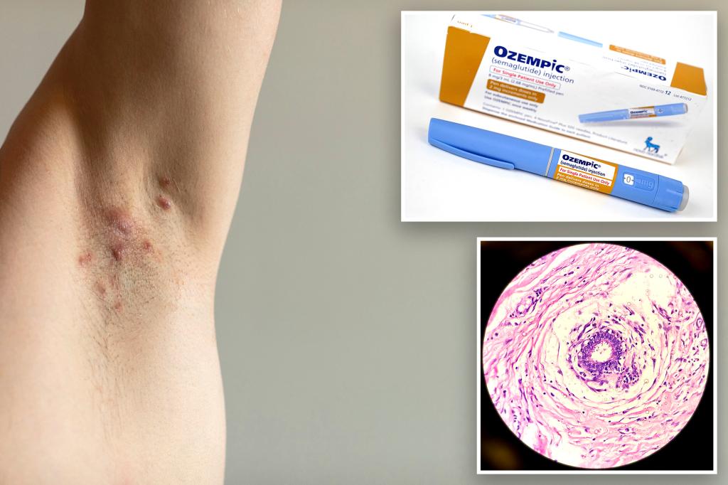 Ozempic may improve a common, chronic skin condition, a new study claims